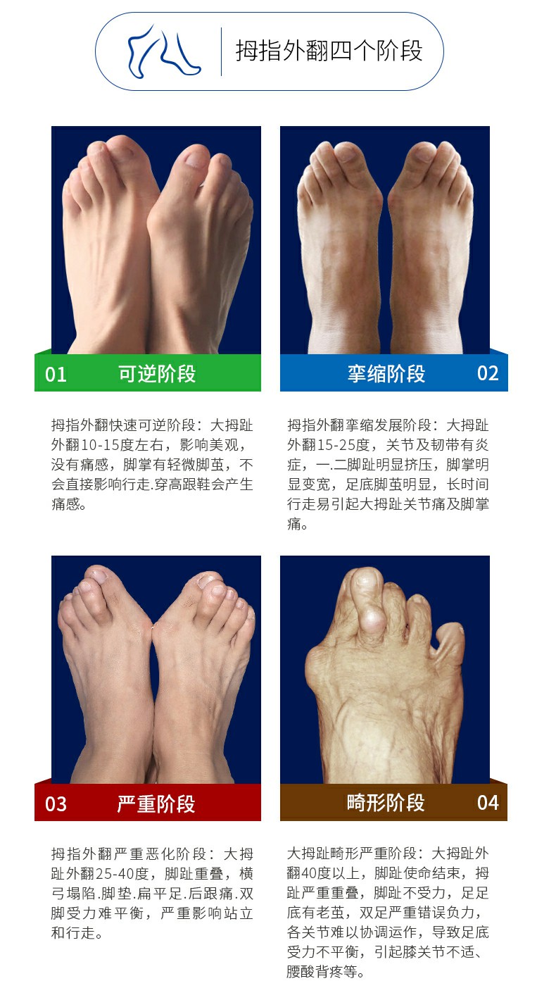 敏斯特矫正器专卖店_拇外翻矫正器推荐_拇外翻矫正器多少钱_大脚骨